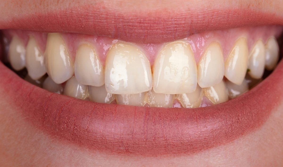 Imagen ilustrativa: sonrisa con dientes amarillentos antes de un blanqueamiento