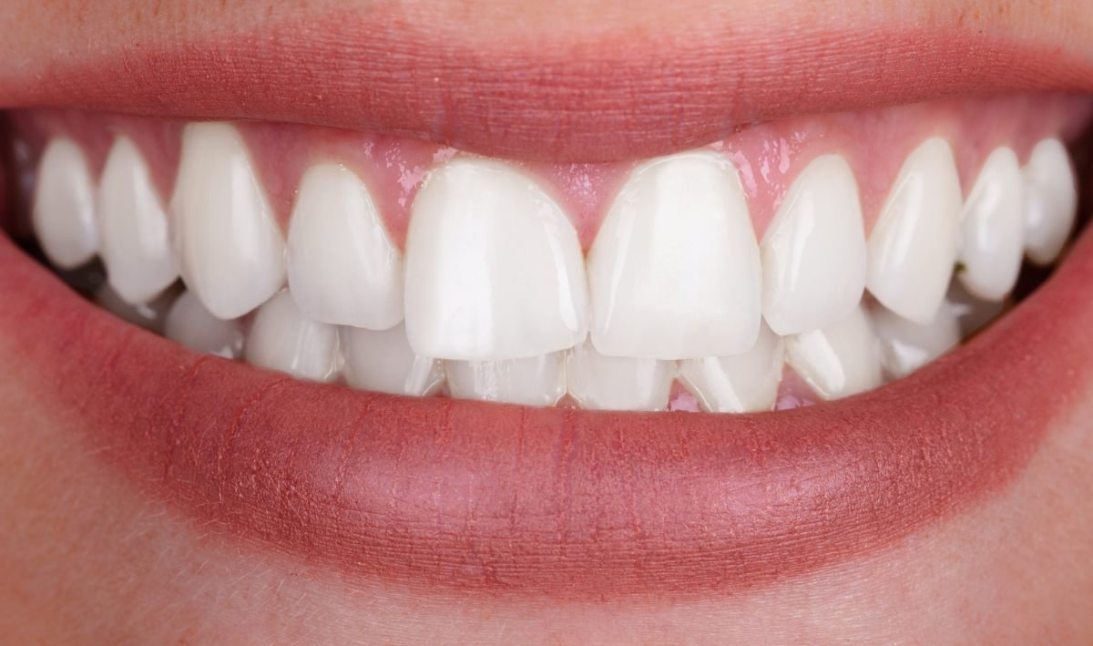 Imagen ilustrativa: la misma sonrisa con dientes blancos después de un blanqueamiento