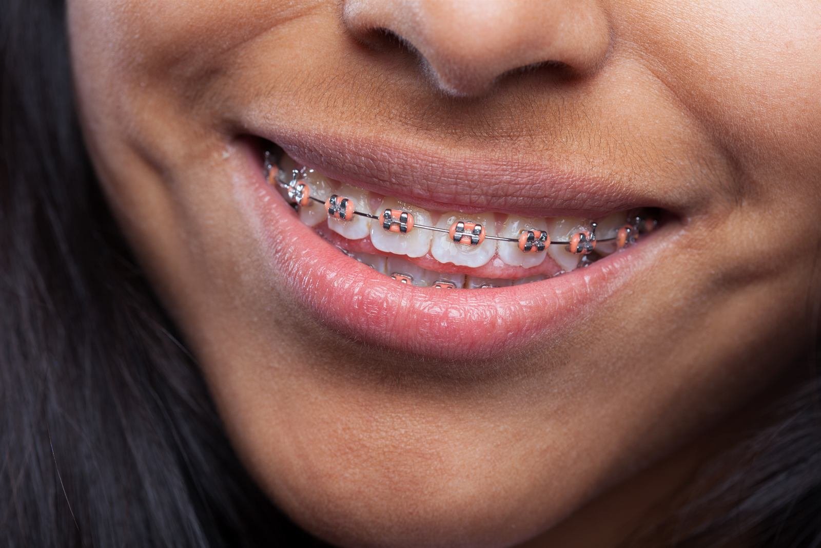 Sonrisa con brackets de ortodoncia